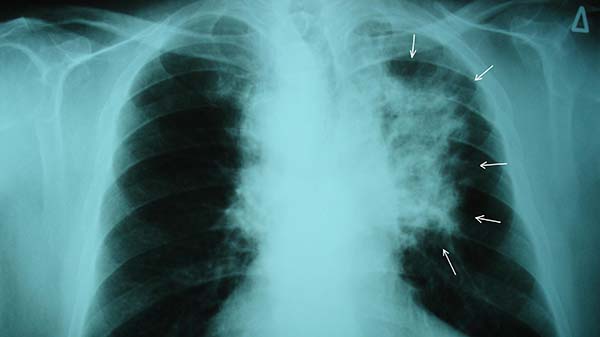 Lung Cancer in Xray
